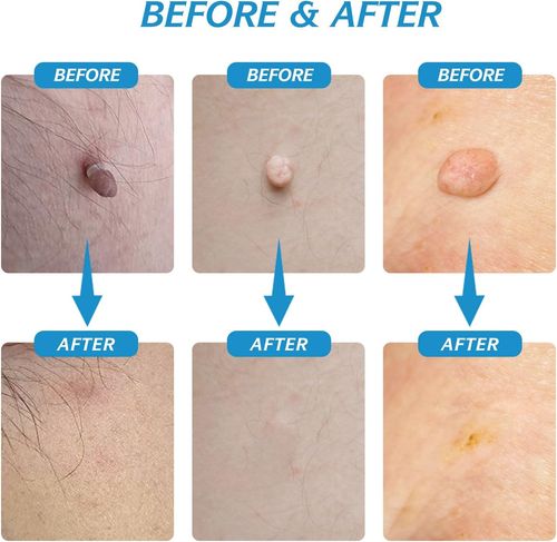 Skin Tag Remover, Auto Skin Tag Remover Kit, 2-in-1 Fast Skin Tag Removal Kit