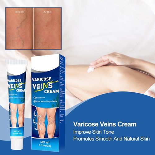 Varicose vein cream, leg care ointment, suitable for leg care, shimmering legs for men and women, 20g