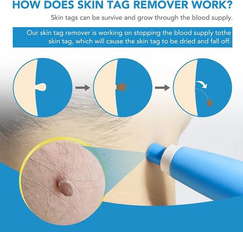 2 in 1 Skin Tag Remover Kit, (2mm to 8mm) Skin Tag and  Moles Removal Kit, Auto Skin Tag Remover Pen, Painless Skin Tag Mole Wart Removal Kit for All Body Parts
