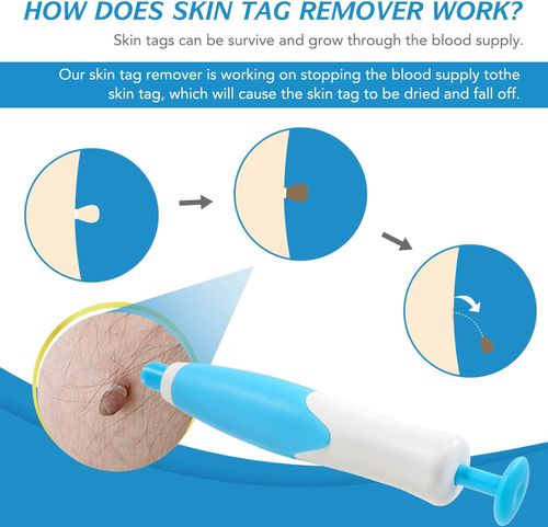 Skin Tag Remover, Auto Skin Tag Remover Kit, 2-in-1 Fast Skin Tag Removal Kit