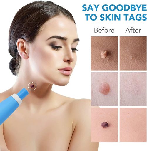 2 in 1 Skin Tag Remover Kit, (2mm to 8mm) Skin Tag and  Moles Removal Kit, Auto Skin Tag Remover Pen, Painless Skin Tag Mole Wart Removal Kit for All Body Parts