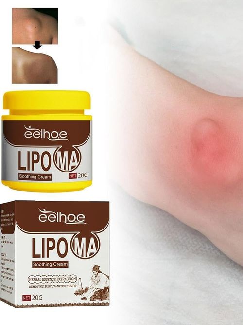 Eliminating lipomas, anti-lipomas, natural lipomas, skin conditions, eliminating intermediate lipomas, and eliminating various types of accumulated lipomas.