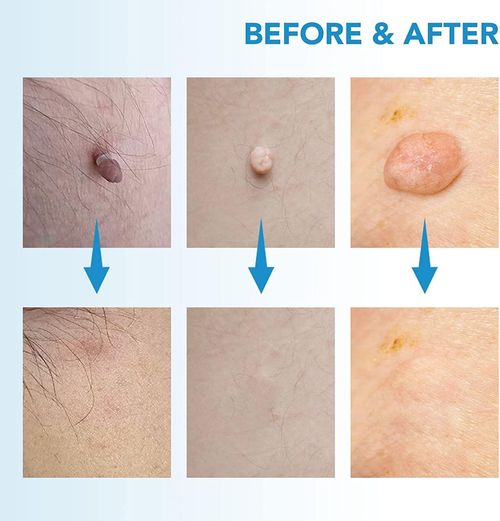 2 in 1 Skin Tag Remover Kit, (2mm to 8mm) Skin Tag and  Moles Removal Kit, Auto Skin Tag Remover Pen, Painless Skin Tag Mole Wart Removal Kit for All Body Parts