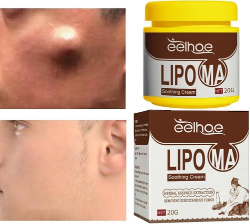 Eliminating lipomas, anti-lipomas, natural lipomas, skin conditions, eliminating intermediate lipomas, and eliminating various types of accumulated lipomas.