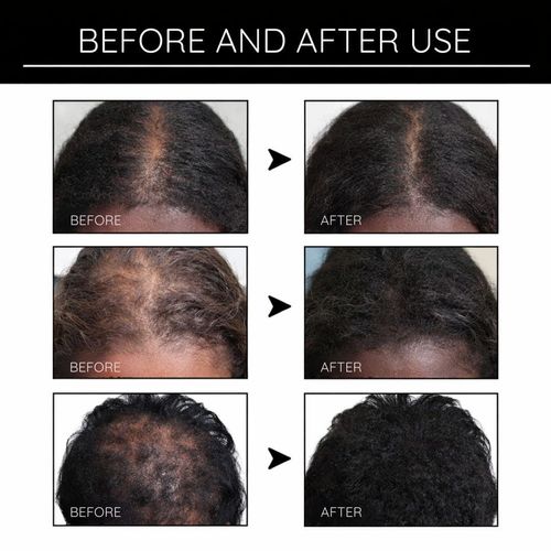 Buy 1, Get 1 Free✨-Hair Growth Boost Serum-Powerful Hair Growth & Nourishing Care — No More Hair Loss Worries✨