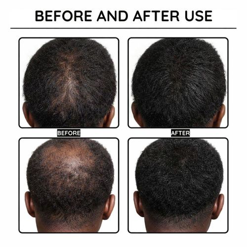 Buy 1, Get 1 Free✨-Hair Growth Boost Serum-Powerful Hair Growth & Nourishing Care — No More Hair Loss Worries✨
