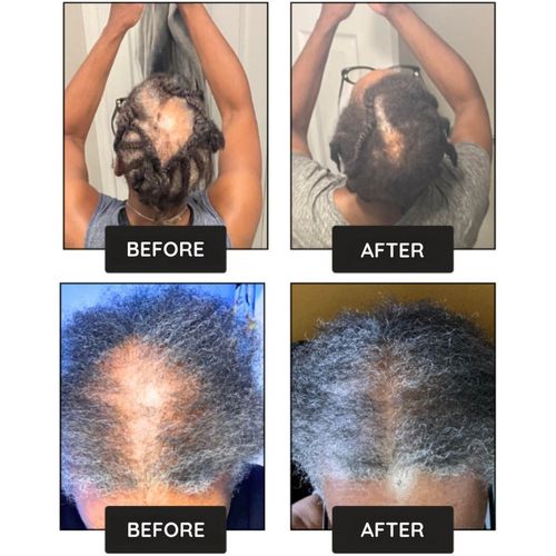 Buy 1, Get 1 Free✨-Hair Growth Boost Serum-Powerful Hair Growth & Nourishing Care — No More Hair Loss Worries✨
