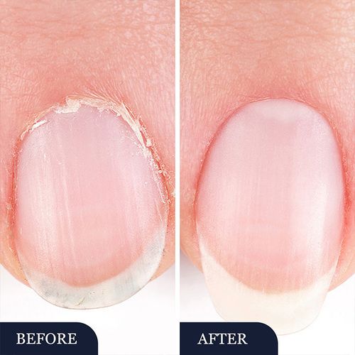 Nail fungus treatment pen for damaged nails