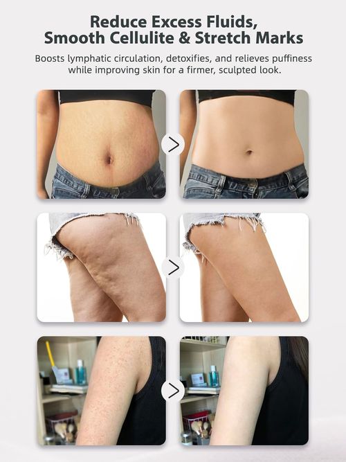 Lymphatic drainage massager and anti-cellulite massage tool, reduces stretch marks and cellulite, for legs, arms and belly, body sculpting machine with microcurrent light