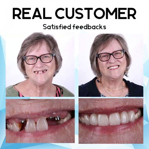 PerfectSmile™ 𝐒𝐢𝐥𝐢𝐜𝐨𝐧𝐞 𝐑𝐞𝐥𝐢𝐧𝐞 𝐃𝐞𝐧𝐭𝐮𝐫𝐞 𝐒𝐞𝐭