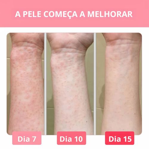Trata doenças de pele, psoríase, dermatite e eczema. Pomada de ervas naturais. Entrega em domicílio, pagamento na entrega.
