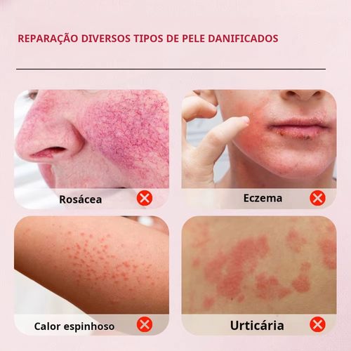 Trata doenças de pele, psoríase, dermatite e eczema. Pomada de ervas naturais. Entrega em domicílio, pagamento na entrega.