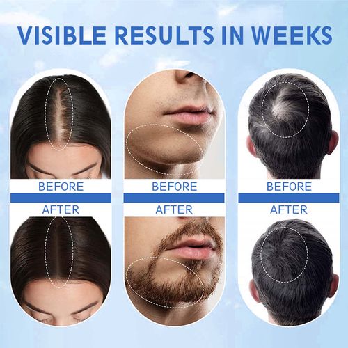 Advanced hair growth serum, hair thickening rollerball essence, anti-hair loss, hair growth essence, 25ml, unisex.