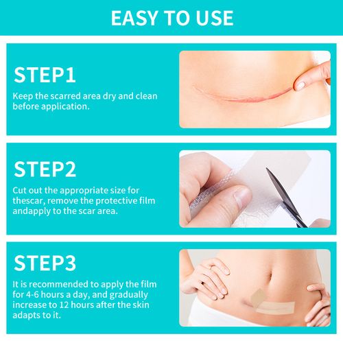 Silicone Scar Patches, Silicone Scar Tape, Silicone Scar Strips—Professional Scar Removal Patches suitable for surgical scars, keloids, C-section scars, burn scars, and more.