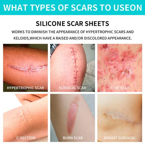 Silicone Scar Patches, Silicone Scar Tape, Silicone Scar Strips—Professional Scar Removal Patches suitable for surgical scars, keloids, C-section scars, burn scars, and more.