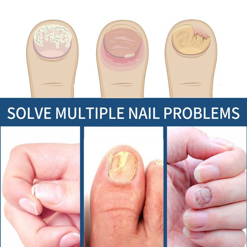 Fungal Nail Patches – 32-Piece Nail Repair Set for Clearer, Healthier Nails ✨