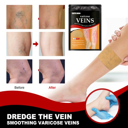 Varicose vein patches, relieve varicose vein blockage and protrusion, cold compress vein health care patches, leg care patches, 12 patches per pack.