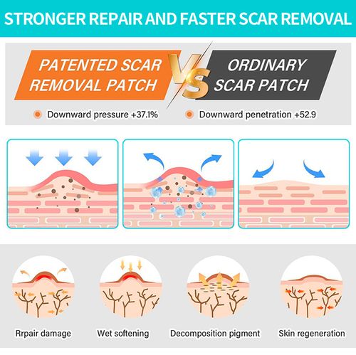 Silicone Scar Patches, Silicone Scar Tape, Silicone Scar Strips—Professional Scar Removal Patches suitable for surgical scars, keloids, C-section scars, burn scars, and more.