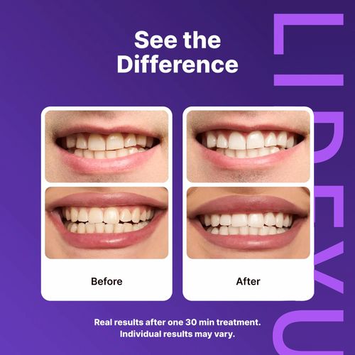 🔬 2-in-1 Purple PAP Teeth Whitening Strips—correct tones and whiten in just 30 minutes! Get the perfect smile! 14 strips, 21 treatments! 📸💜