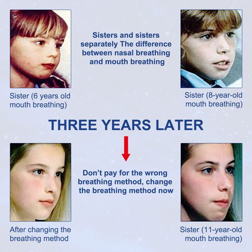 1 Box (120 Patches) — Anti-Mouth Breathing Patches | Sleep Correction Aid | Specialized Anti-Snoring Strips | Mouth-Closing Breathing Patches