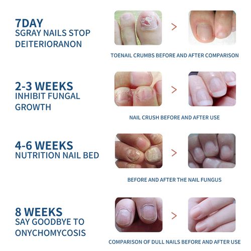 Fungal Nail Patches – 32-Piece Nail Repair Set for Clearer, Healthier Nails ✨