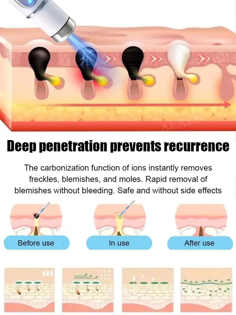⚡ Laser Painless Wart Removal Pen 🖊️