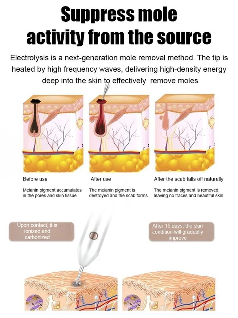 ⚡ Laser Painless Wart Removal Pen 🖊️
