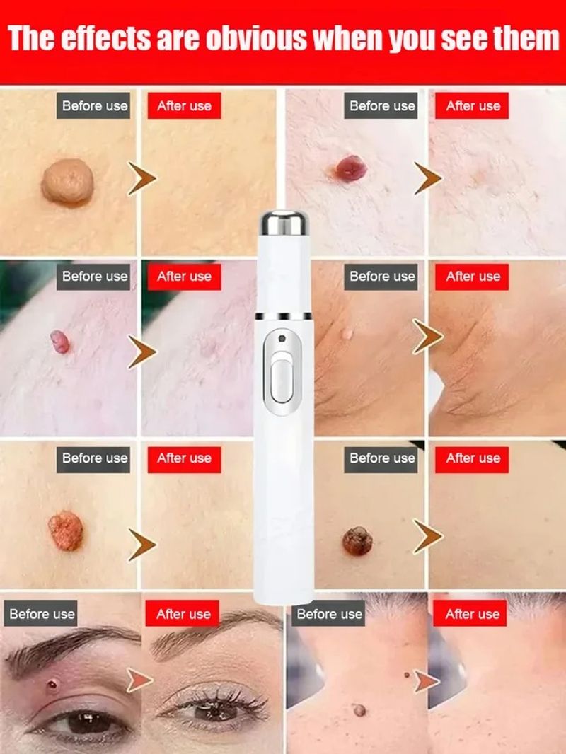 ⚡ Laser Painless Wart Removal Pen 🖊️