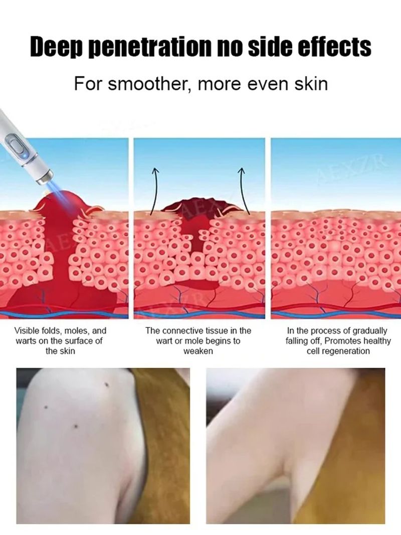⚡ Laser Painless Wart Removal Pen 🖊️