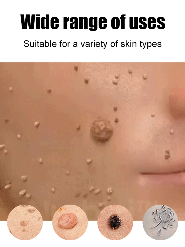 ⚡ Laser Painless Wart Removal Pen 🖊️