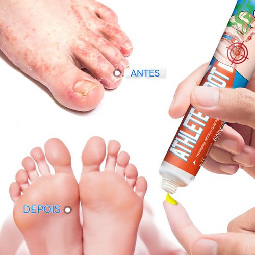 Creme antifúngico, alivia coceira, descamação e pés ressecados！