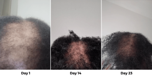 IMAGINE A VIDA SEM CALVÍCIES, BORDAS INVISÍVEIS, CABELOS RALOS E CABELOS ESTAGNADOS...