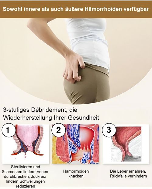 Spray de alívio anal adulto hemorroida quebrada