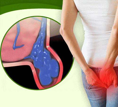 Spray de alívio anal adulto hemorroida quebrada