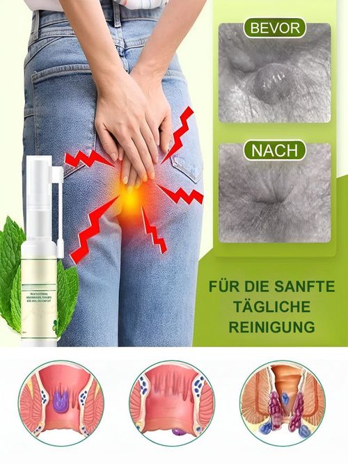Spray de alívio anal adulto hemorroida quebrada