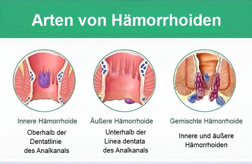 Spray de alívio anal adulto hemorroida quebrada