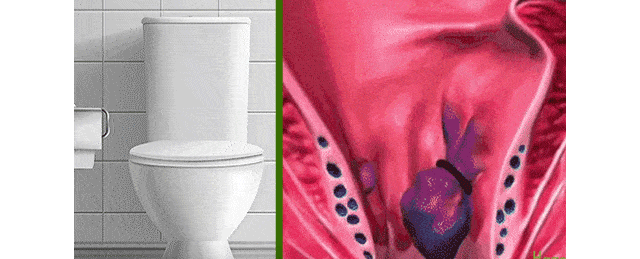 Spray de alívio anal adulto hemorroida quebrada