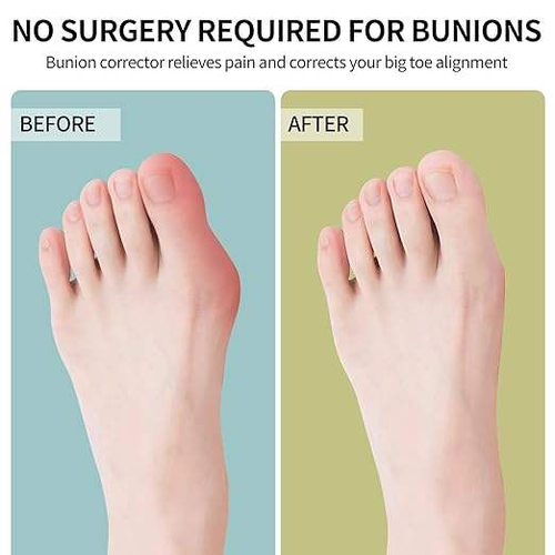 Toe correction strap