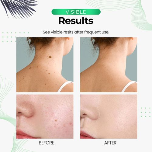 Sabonete Eliminador de Verruga SmoothSkin