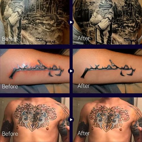 Tattoo Brightening