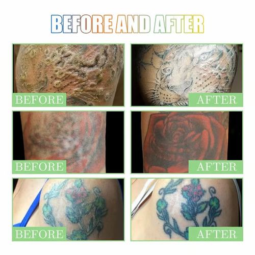 Tattoo Brightening