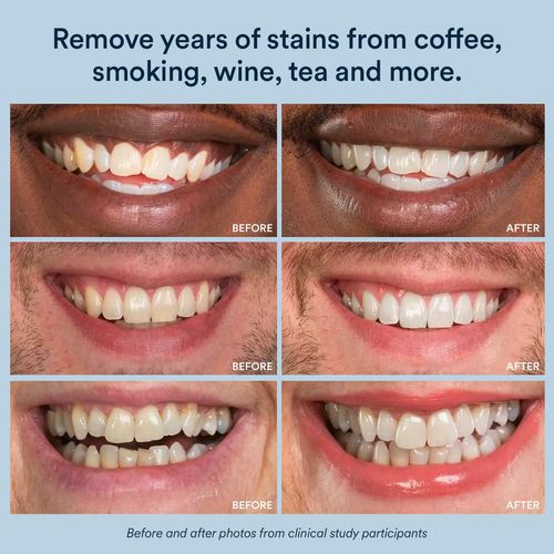 Adesivos para remoção de manchas nos dentes, adesivos para branqueamento dos dentes