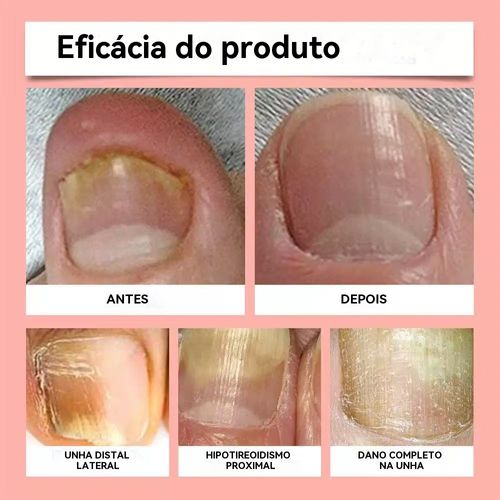 Ximonth Parche de Reparo de Unhas Fungosas🌿 Ingredientes Vegetais Reparo Profundo 8 Horas 21 Parches Uso Dia e Noite