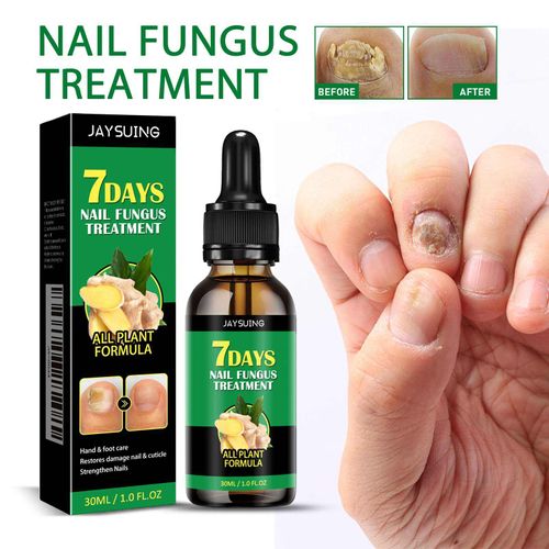 Ginger Nail Care Solution for Gentle Maintenance of Fingernails and Toenails