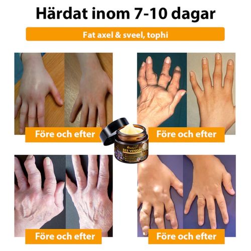 Aetheris™ Bee Venom Arthritis Treatment Cream (👩🏼‍⚕️Especially for Older Adults)