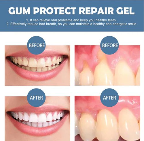 Teeth Whitening Repair Gel
