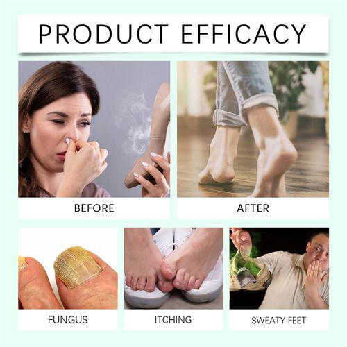 Ximonth 100ml Antimicrobial Foot Sanitizer Fungus Itching Sweaty Feet Treatment Bad Odor Removing Foot Spray with Tea Tree Oil