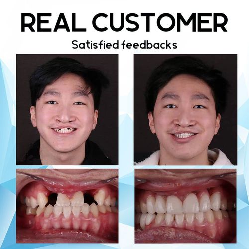 PerfectSmile™ 𝐒𝐢𝐥𝐢𝐜𝐨𝐧𝐞 𝐑𝐞𝐥𝐢𝐧𝐞 𝐃𝐞𝐧𝐭𝐮𝐫𝐞 𝐒𝐞𝐭