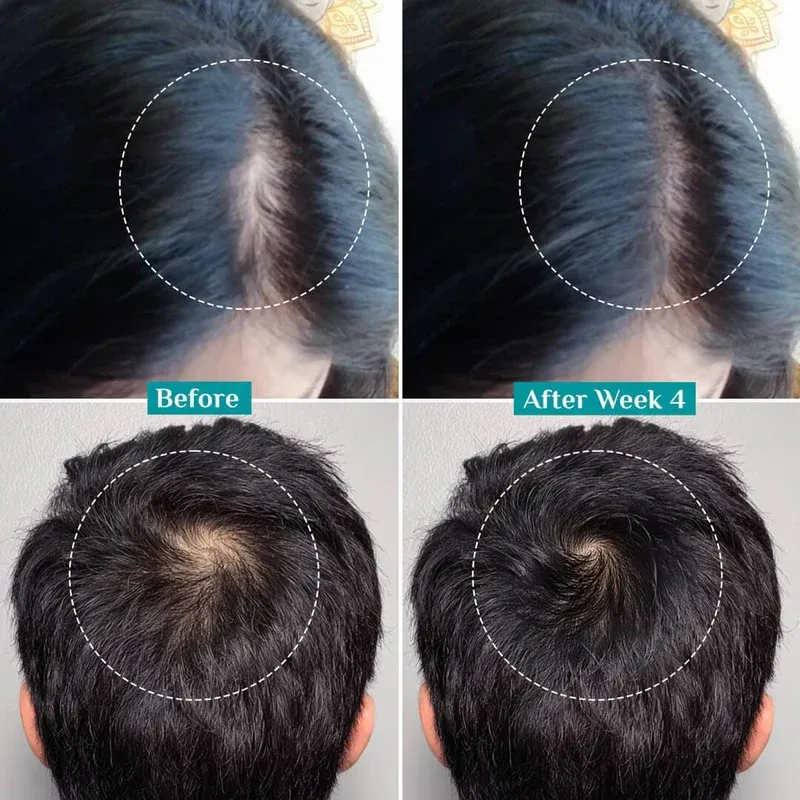 3% Redensyl, 4% Anagain & 5% Capilia Stem Cell Complex Advanced Hair Growth Serum(Buy One, Get One Free)