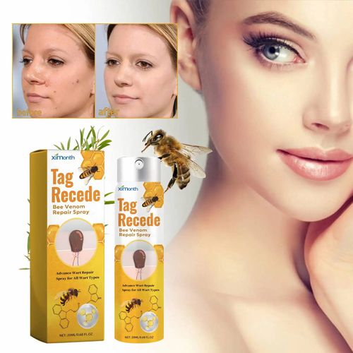 Tag & Wart Remover Spray - Wart and Tags Removal Treatment Spray